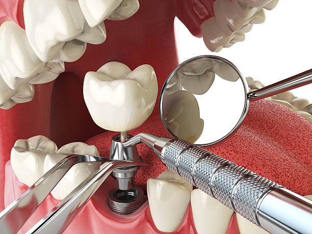 Best Emergency Root Canal Treatment in Russell, GA